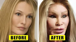 OMG! 10 Celebrity Plastic Surgery Disasters