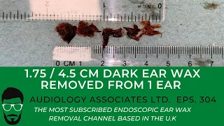 1.75IN/4.5CM DARK EAR WAX REMOVED FROM 1 EAR - EP 304