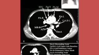 CT MRI CHEST ANATOMY Dr AHMED EISAWY