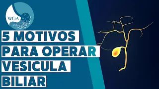 5 MOTIVOS PARA OPERAR VESÍCULA BILIAR