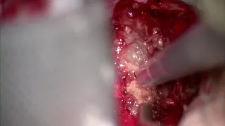 Surgical Strategy in Large Vestibular Schwannoma
