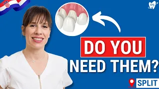 Dental Veneers in Split, Croatia: SEE if You’re Eligible! (Testimonial INSIDE)