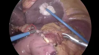 Laparoscopic pancreaticojejunostomy with Barber Suture