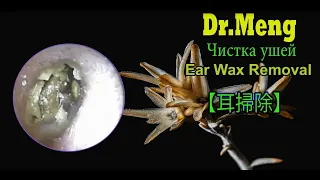 うじ耳垢|Ear Wax Extraction|удаление самой большой ушной серы