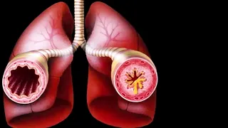 Ayurvedic treatment for Asthma - Dr. Nidhi Navani