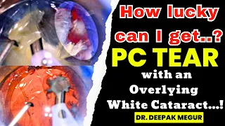 How lucky can I get..? PC tear with an Overlying White Cataract...! - Dr. Deepak Megur