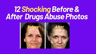 Top 12 Shocking Before & After Drug Abuse Photos