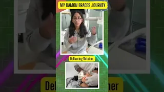 Dental Retainers - My  Damon Braces Journey || #shorts