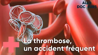 Thrombose : toutes vos questions - Allo Docteurs