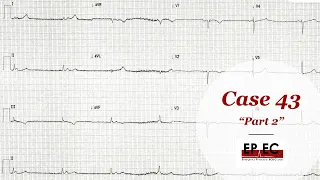 #EPEC​​​ ECG Cases (Case 43) part 2, Why not IRAVD??