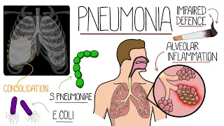 Pneumonia Explained Clearly (Includes Community & Hospital Acquired)