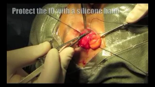 Fat removal orbital decompression by Dr Hunter Yuen