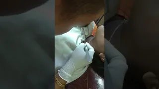 Dermal piercing removal