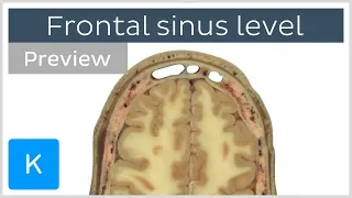 Cross section at the level of the frontal sinus (preview) - Human Anatomy | Kenhub
