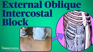 External Oblique Intercostal Fascial Plane Block