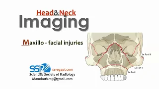 10 Maxillo-facial Injuries- prof.Mamdouh Mahfouz (2019 edition)