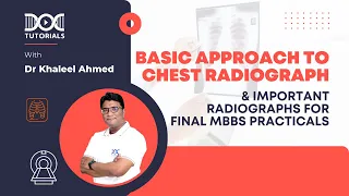 Basic Approach to Chest Radiograph & Important Radiographs for Final MBBS Practical's | DocTutorials