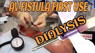 Dialyse: First time use of an AV Fistula at Stavanger University Hospit