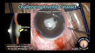 CataractCoach 1407: challenging uveitic cataract