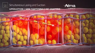 Liposuction, Skin Tightening & Fat Grafting - Lipo Life by Alma Lasers (Medical Device 3D Animation)