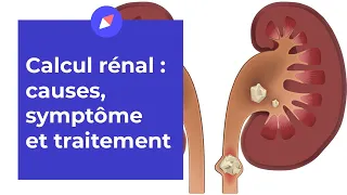 Comment savoir si j'ai des calculs rénaux ?
