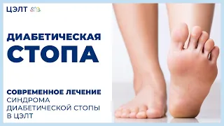 Диабетическая стопа. 👣 Современное лечение синдрома диабетической стопы в ЦЭЛТ