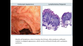 Gastrointestinal Pathology Case Review