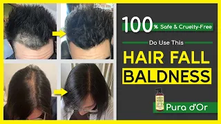Best way to get rid of Hair loss or Baldness || Hair fall solution | baldness treatment | Pura d'Or