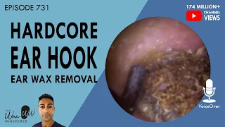 731 - Hardcore Ear Hook Ear Wax Removal