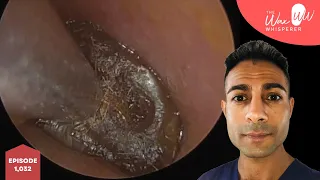 1,032 - Extremely Wedged Ear Wax Removal