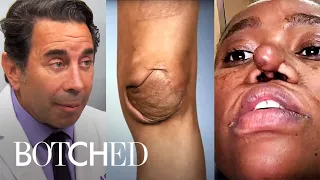 "Botched" Returns With Weird Knee & Nose Cases | Botched | E!