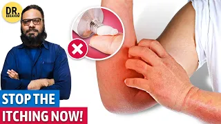 Kharish Ka Khatma! Stop Itchy, Red Bumpy Skin, Eczema! (Urdu/Hindi) Dr. Ibrahim