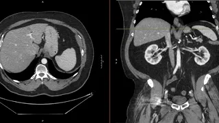 Lymph Nodes