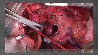 Aortic Arch FET Case with E-vita OPEN NEO performed by Prof. Castiglioni, Dr. Bertoglio and the team