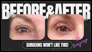 SKIP the surgery. This eyelid treatment WORKS!! TIXEL eyelid LIFT