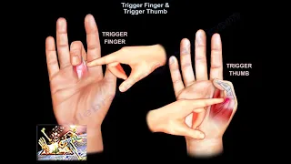 Trigger Finger & Trigger Thumb - Everything You Need To Know - Dr. Nabil Ebraheim