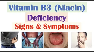 Vitamin B3 (Niacin) Deficiency Signs & Symptoms (Skin, Hair, Gastrointestinal, Psychiatric)