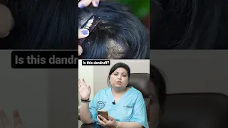 Is Pityriasis Amiantacea a Dandruff?(क्या पिट्रीएसिस एमिएन्टसेआ एक रूसी है?) |#youtubeshorts #shorts