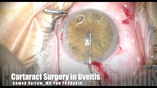 Uveitic Cataract Surgery
