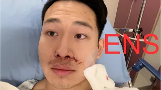 Deviated Septum Surgery - 2 Week Review and Recovery | Septoplasty and Turbinate Reduction