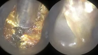 100 - One Hundred Years of Ear Wax Removal with the WAXscope®️!