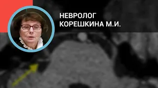 Невролог Корешкина М.И.: Дифференциальная диагностика головных болей