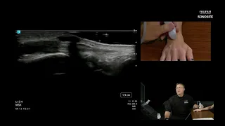 Webinar: Ultrasound Evaluation of the Dorsal Wrist