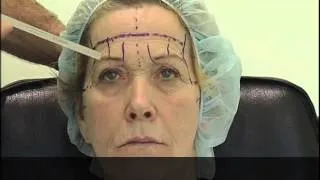 Lifting endoscopico del viso MIVEL: Disegno preoperatorio
