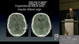 Neuro - Stroke diagnosis, mimics and treatment 1