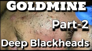 Goldmine of Deep Blackheads Part-2