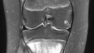 Tibial stress fracture