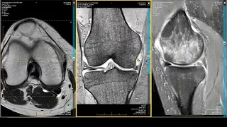 Knee MRI - Meniscocapsular Separation and Subchondral Insufficiency Fracture (SIF)