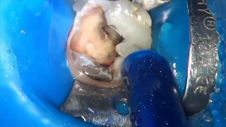 Удаление нерва, чистка каналов зуба, как выглядит зубной нерв