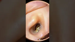 #5 Synthesis #earwaxremoval #earcleaningvideos #ceradeouvido #earwaxcleaning #limpezadeouvido